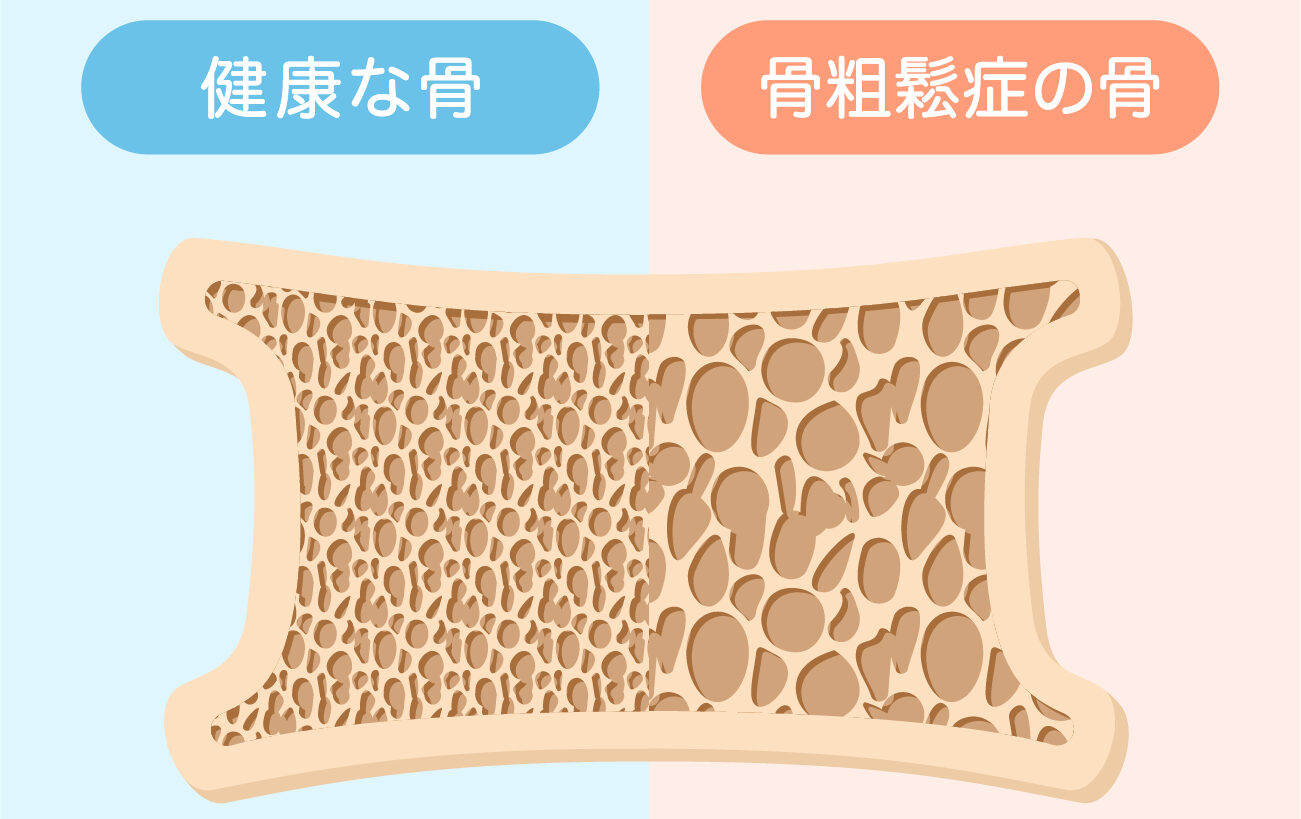 研究者は、幹細胞が骨粗鬆症患者をどのように助ける可能性があると考えていますか?
